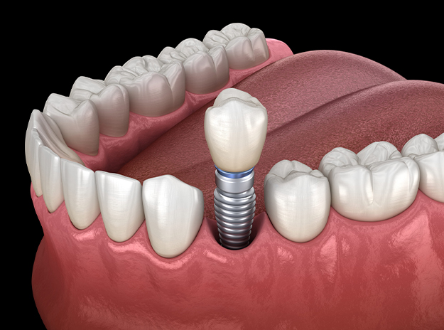 Dental Implant